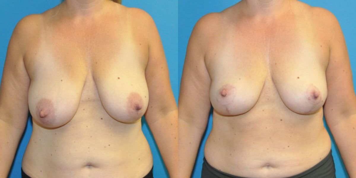 Breast Lift #14 - Before and After