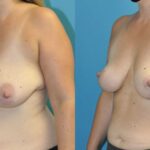 Breast Lift #14 - Before and After