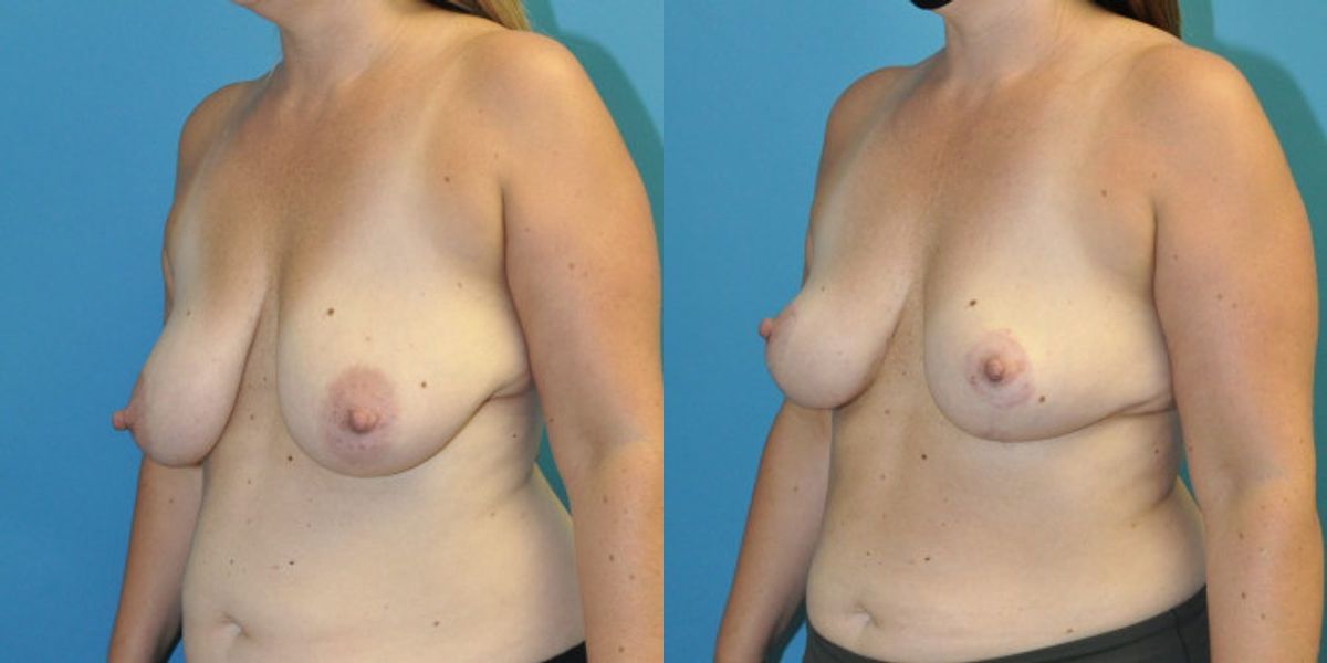 Breast Lift #14 - Before and After