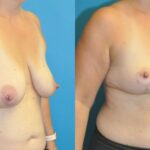 Breast Lift #14 - Before and After