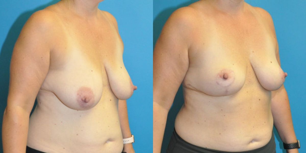 Breast Lift #14 - Before and After