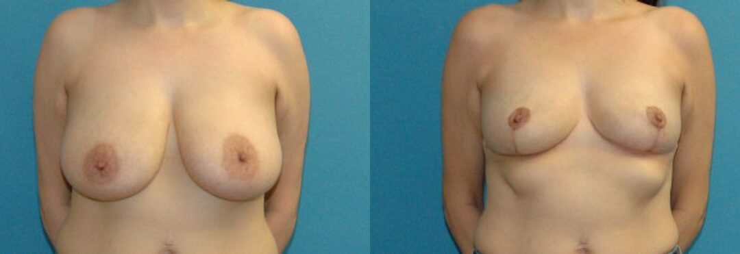 Breast Lift #15