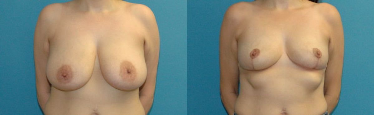 Breast Lift #15 - Before and After