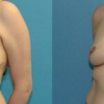 Breast Lift #15 - Before and After