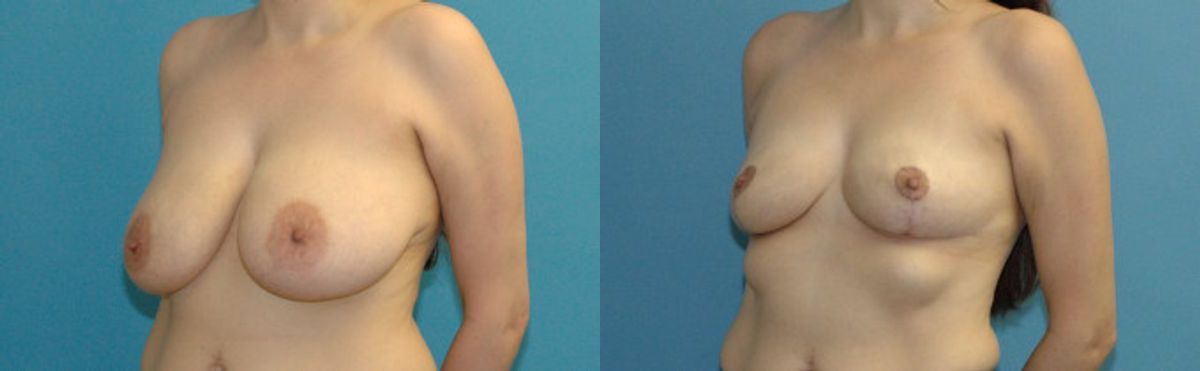 Breast Lift #15 - Before and After