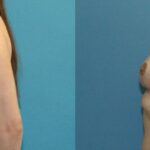 Breast Lift #15 - Before and After