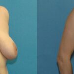 Breast Lift #15 - Before and After