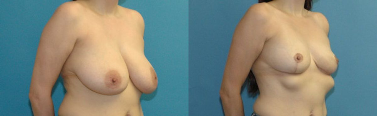Breast Lift #15 - Before and After