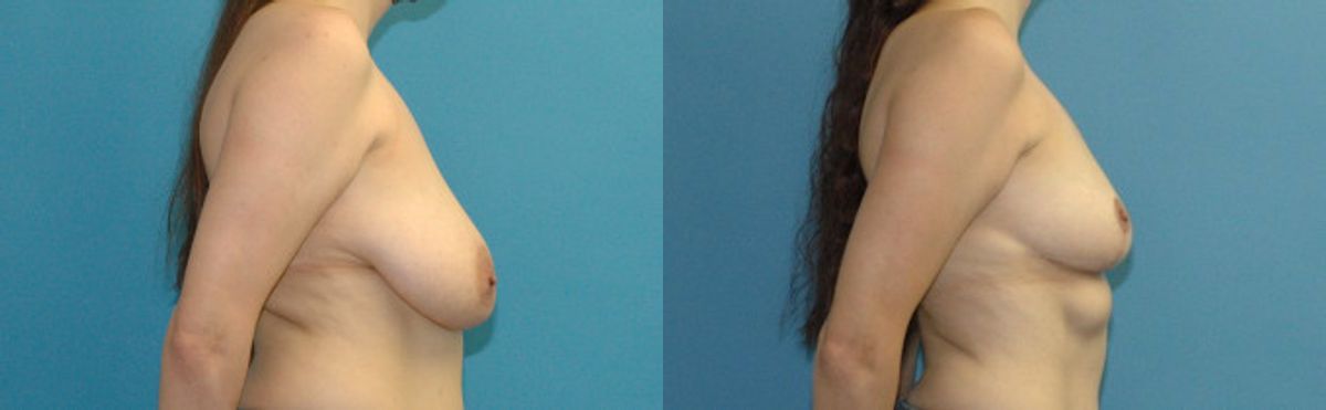 Breast Lift #15 - Before and After