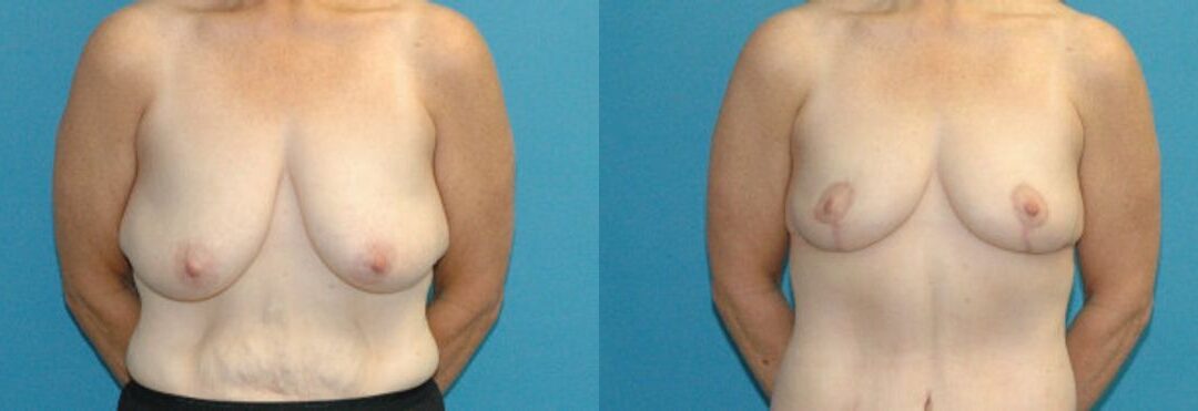 Breast Lift #16