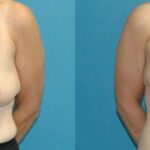 Breast Lift #16 - Before and After
