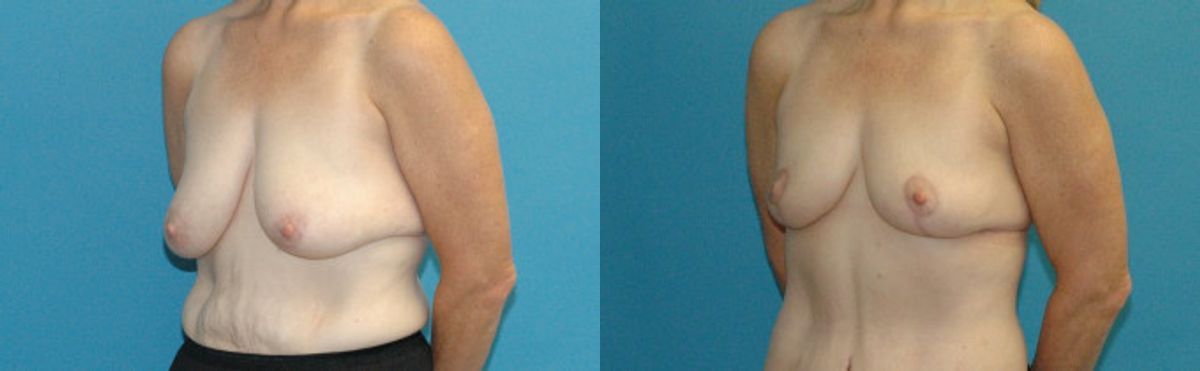 Breast Lift #16 - Before and After