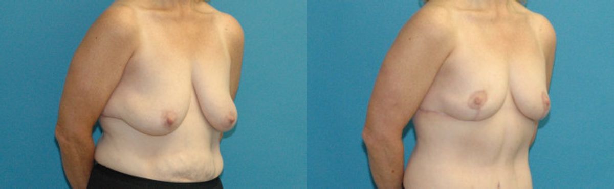 Breast Lift #16 - Before and After
