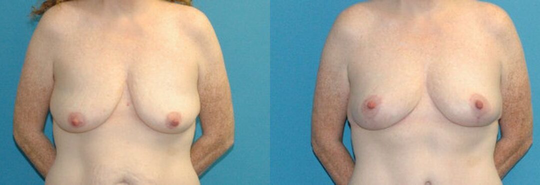 Breast Lift #17