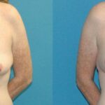Breast Lift #17 - Before and After