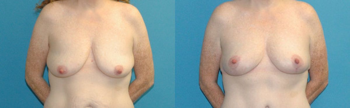 Breast Lift #17 - Before and After