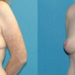 Breast Lift #17 - Before and After
