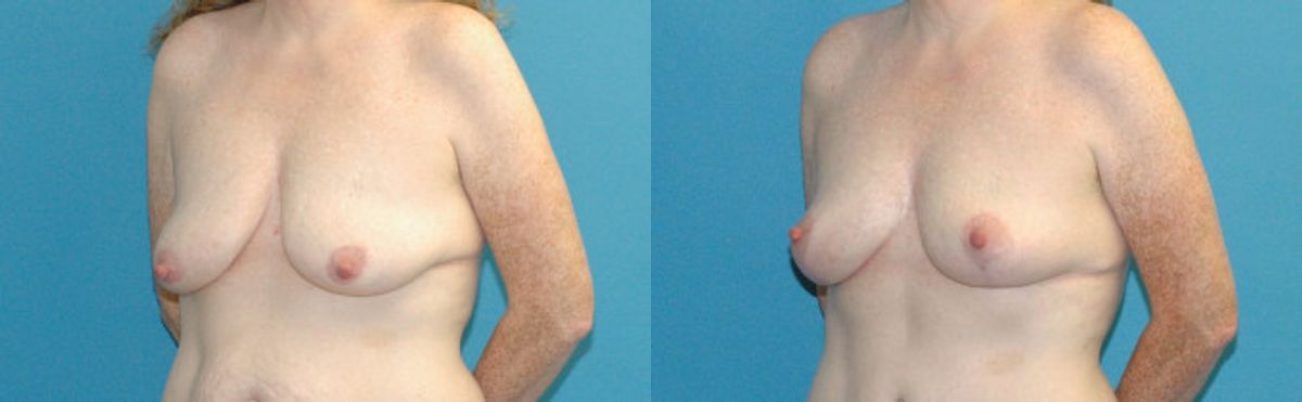 Breast Lift #17 - Before and After