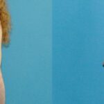 Breast Lift #17 - Before and After