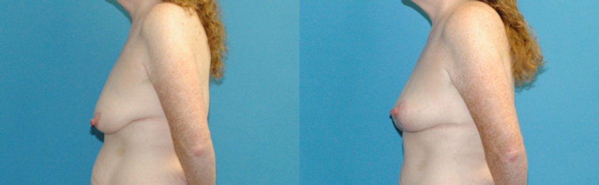 Breast Lift #17 - Before and After