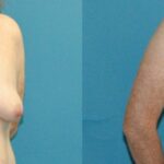 Breast Lift #17 - Before and After
