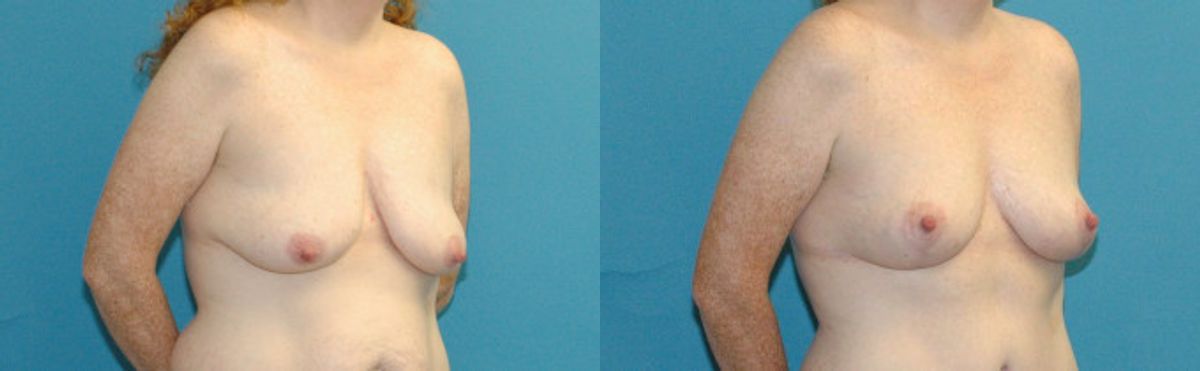 Breast Lift #17 - Before and After