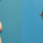 Breast Lift #17 - Before and After