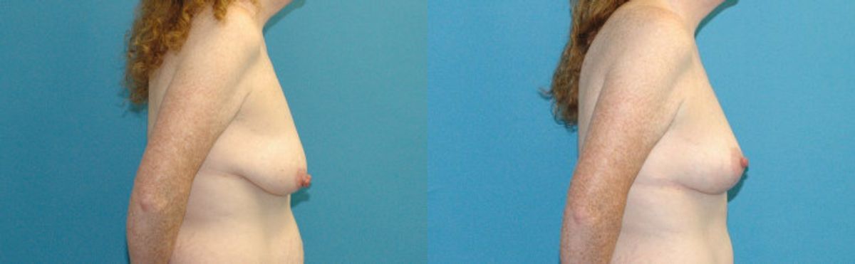 Breast Lift #17 - Before and After