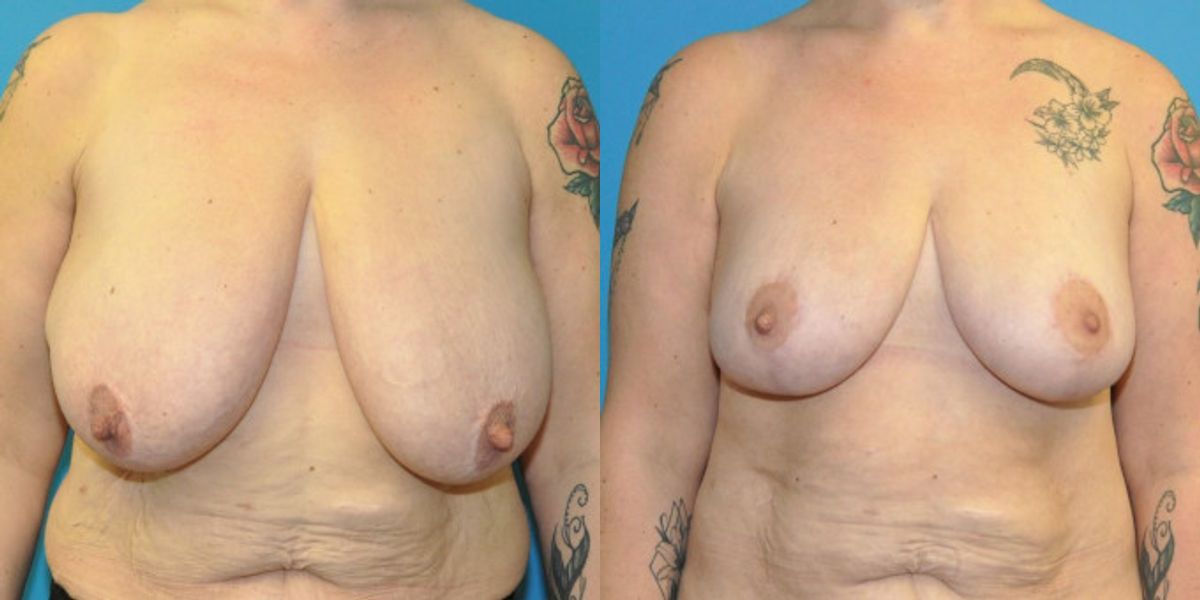 Breast Lift #18 - Before and After