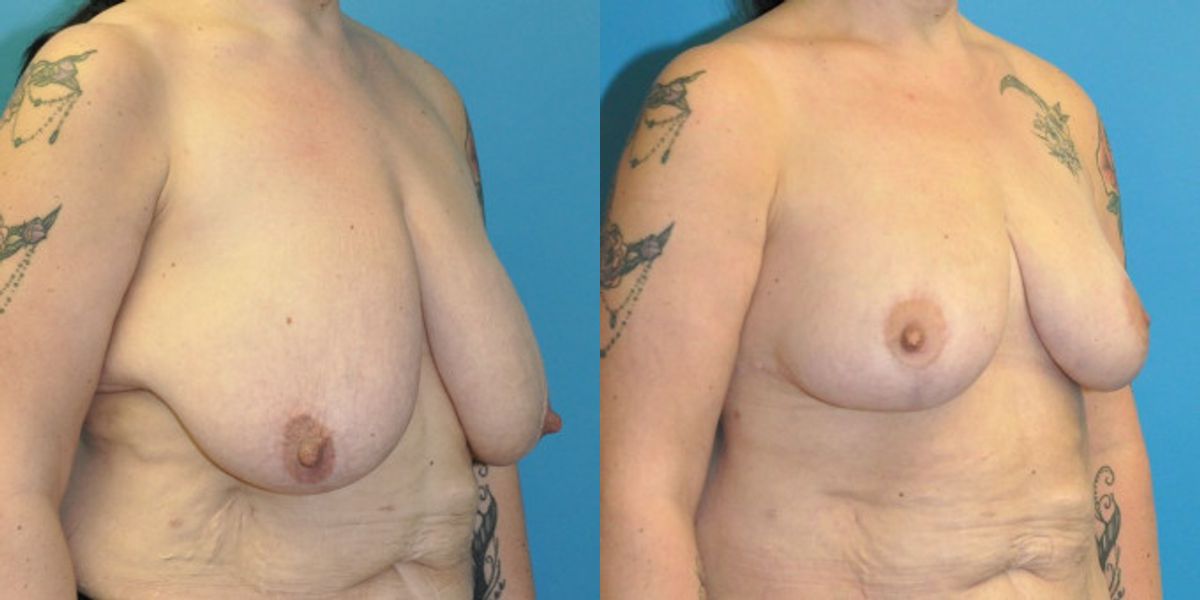 Breast Lift #18 - Before and After