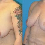 Breast Lift #18 - Before and After