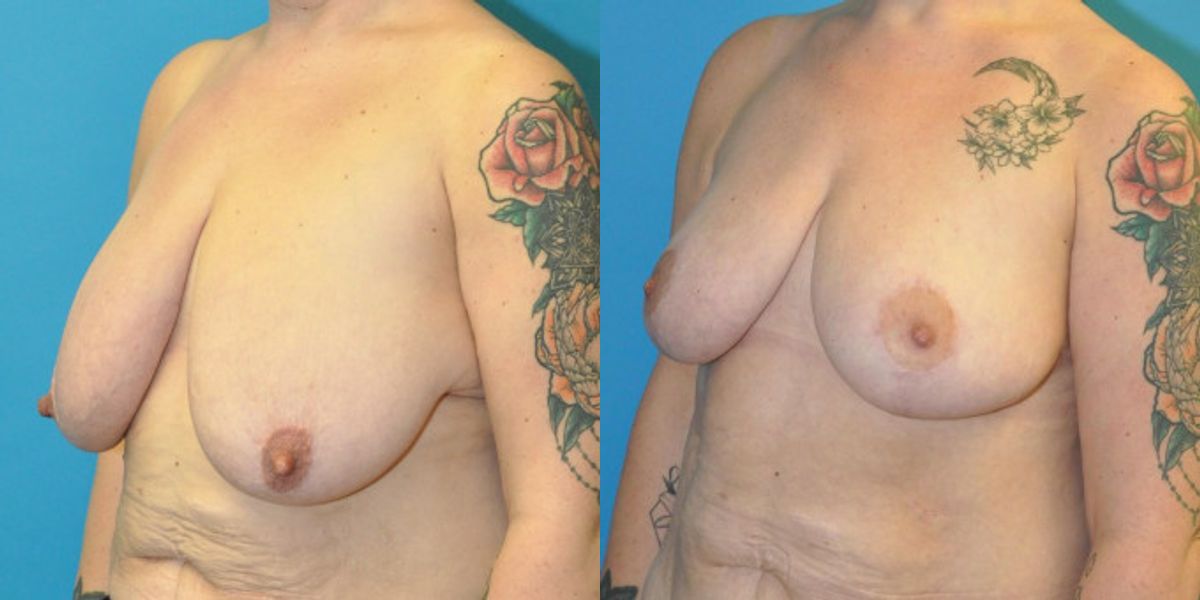 Breast Lift #18 - Before and After