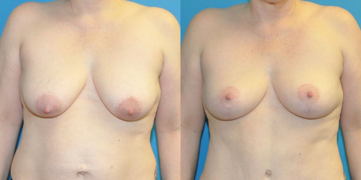 Breast Lift #19 - Before and After