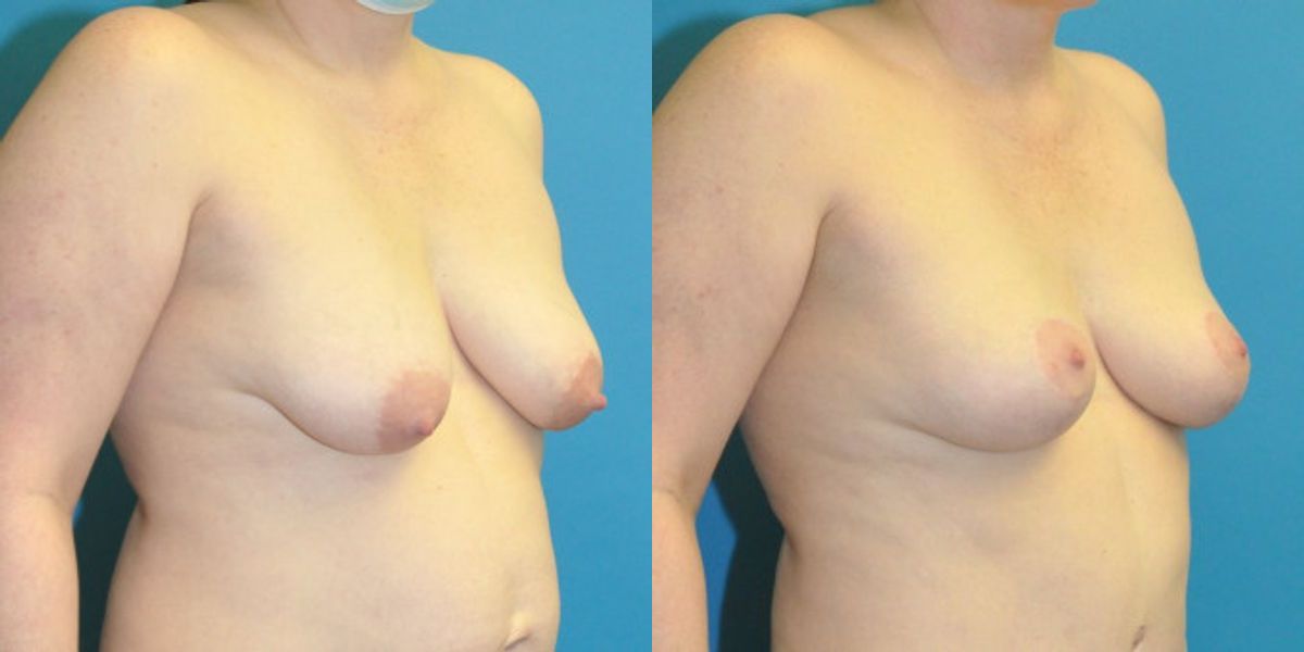 Breast Lift #19 - Before and After