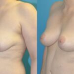 Breast Lift #19 - Before and After