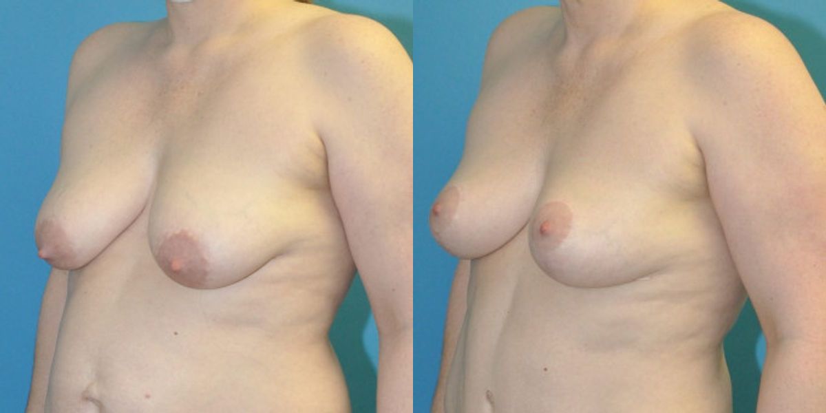 Breast Lift #19 - Before and After