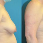 Breast Lift #19 - Before and After