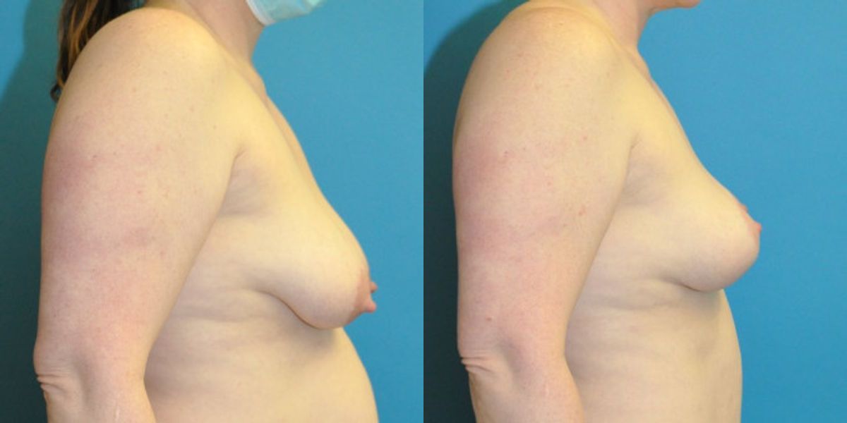 Breast Lift #19 - Before and After