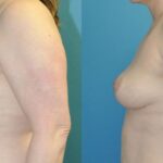 Breast Lift #19 - Before and After