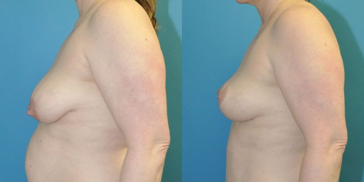 Breast Lift #19 - Before and After