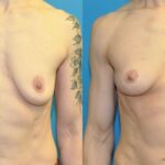 Breast Lift #20 - Before and After