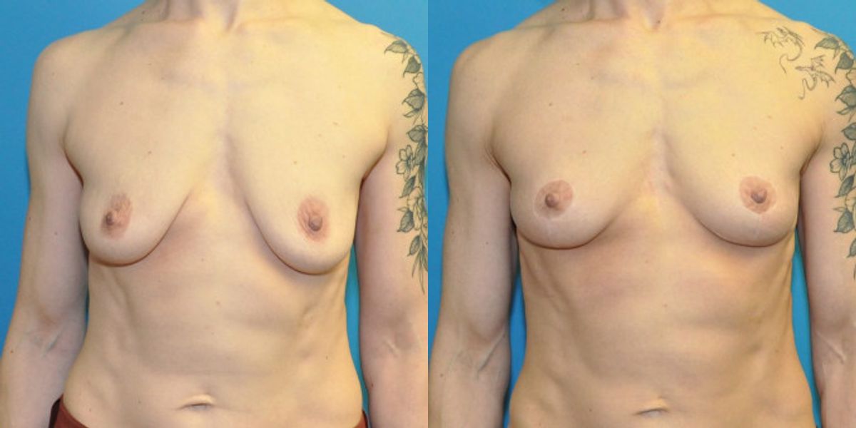 Breast Lift #20 - Before and After