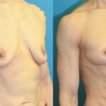 Breast Lift #20 - Before and After