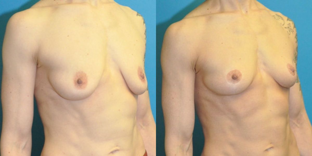 Breast Lift #20 - Before and After