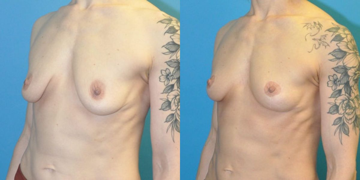 Breast Lift #20 - Before and After