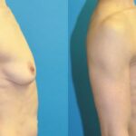 Breast Lift #20 - Before and After