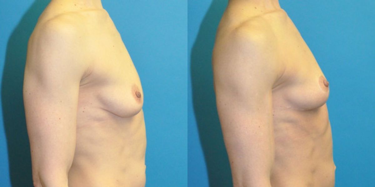 Breast Lift #20 - Before and After