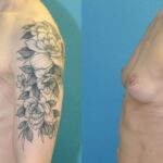 Breast Lift #20 - Before and After
