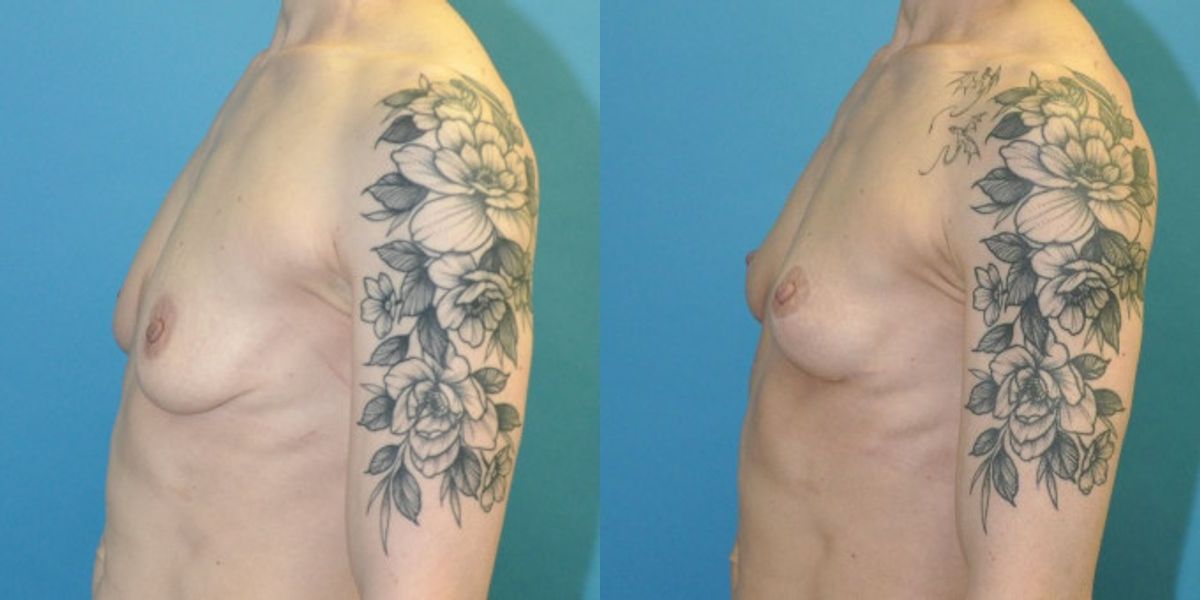 Breast Lift #20 - Before and After