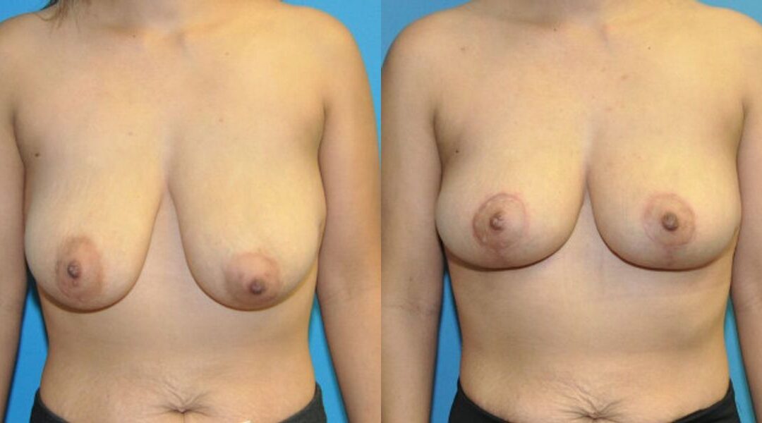Breast Lift #21